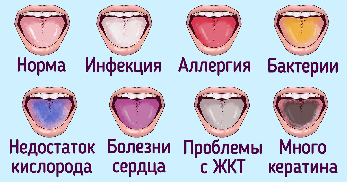 Цвет языка о чем говорит таблица Диагностика языка