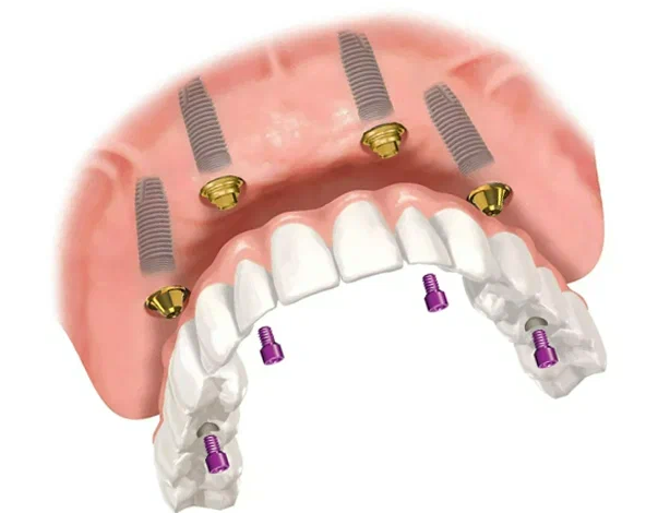 протезирование отзывы вологда. сахно стоматологическая клиника тольятти.