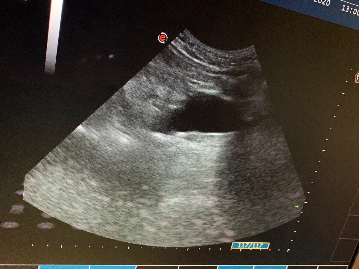 Признаки аневризмы на УЗИ