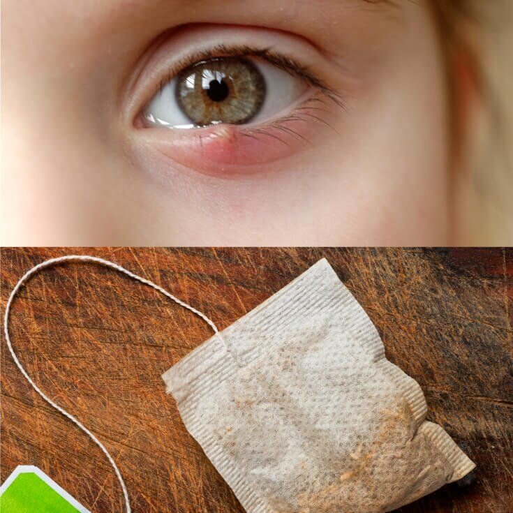 Как лечить ячмень на глазах ребенка 👀 Информационный портал Детское зрение