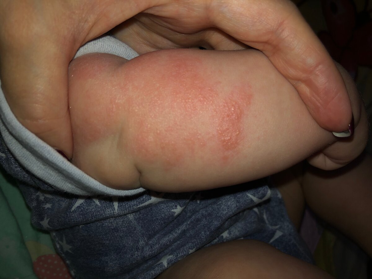 Прививка обернулась для нас дерматитом!