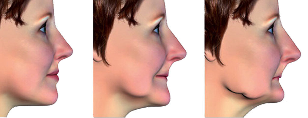 Огромные висячие губы. Снижение высоты нижней трети лица. Атрофированный подбородок. Снижение высоты Нижнего отдела лица.