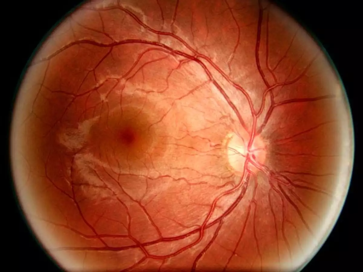 Rhegmatogenous retinal detachment: The University of Iowa, Ophthalmology Opticia