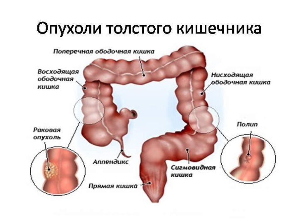 Рак толстой кишки картинки