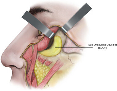 Suborbicularis oculi fat