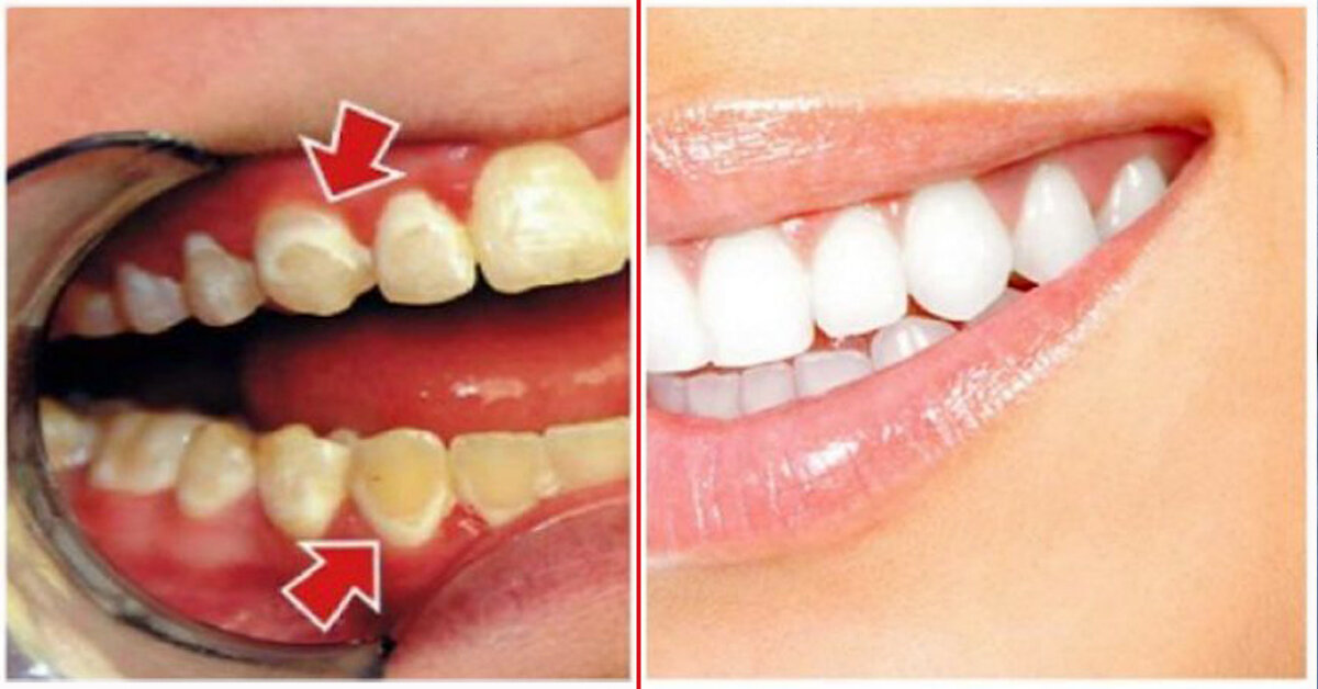 Как убрать зубной камень в домашних условиях и когда без помощи стоматолога не обойтись