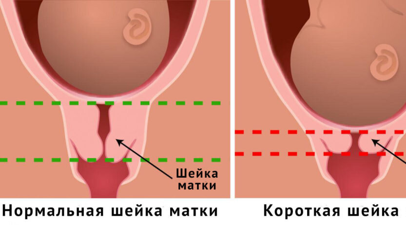 Выпадение и опущение органов малого таза