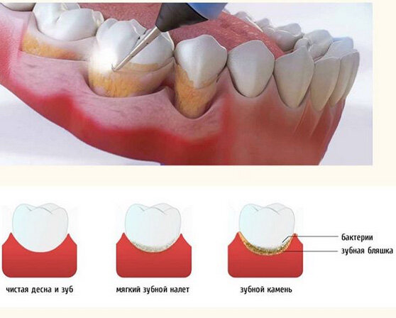 Камень на нижних зубах фото Как образуется зубной камень? Mr Medic Дзен