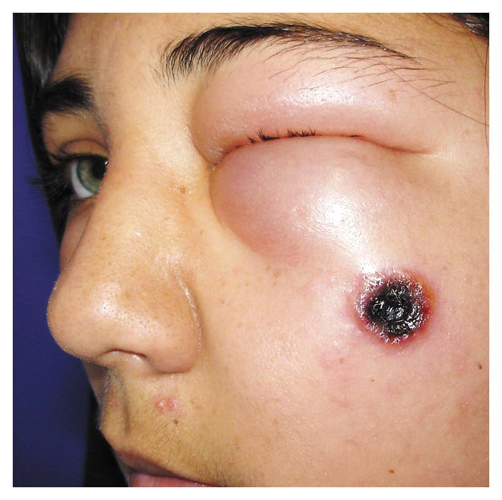 https://www.nejm.org/doi/full/10.1056/NEJMicm0802093