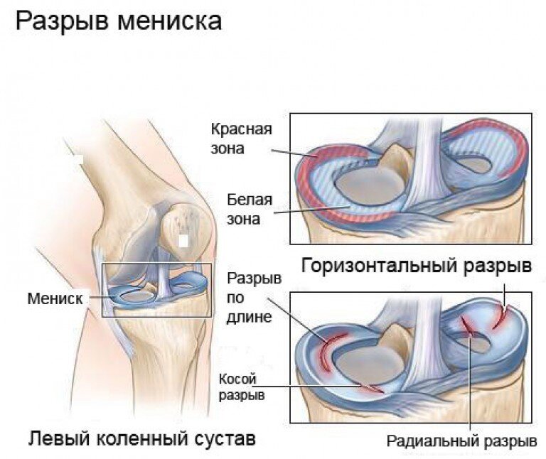 Разрыв мениска картинки