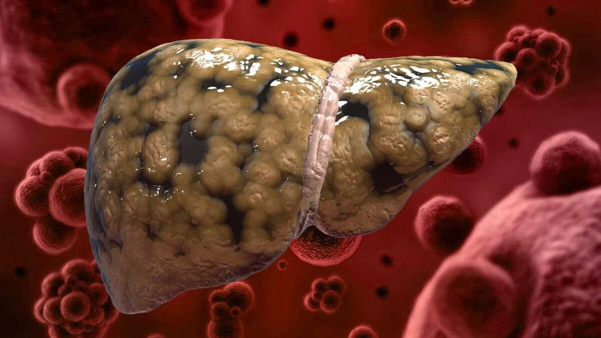 Хроническое повреждение печени не имеет клинических проявлений и, как правило, диагностируется случайно, при лабораторном обследовании/фото Gepatit-abc.ru