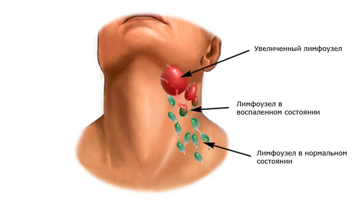 Почему воспаляются лимфоузлы на шее - что делать, причины и лечение