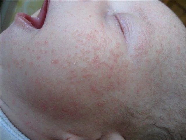 Сыпь на лице у новорожденного: причины появления сыпи на лице, голове и шее, возможное лечение