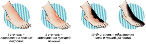 Степени ожогов