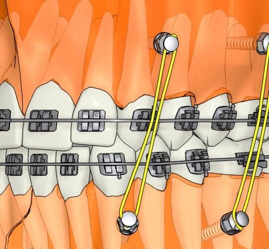 микроимпланты