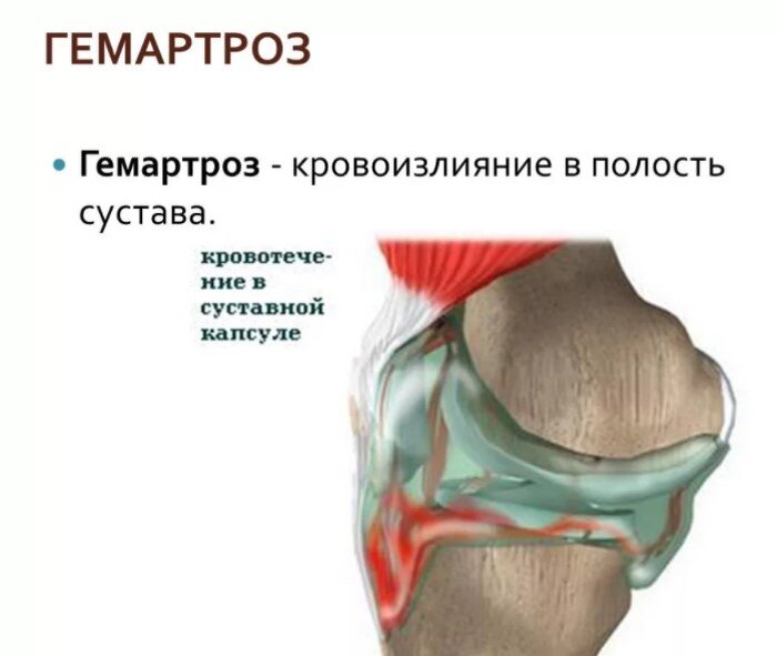 Что такое гемартроз?