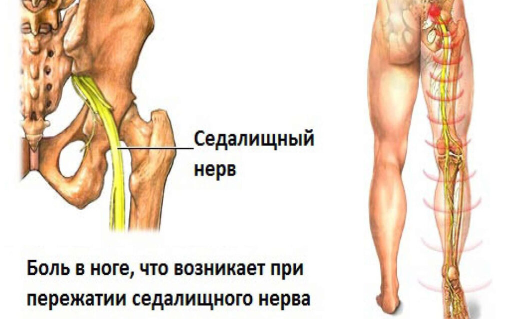 Защемление седалищного нерва - симптомы и лечение