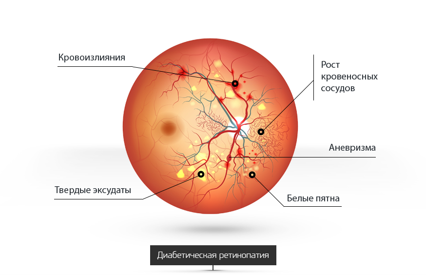 Влияние диабета на зрение