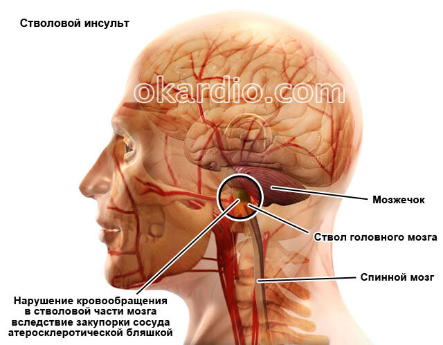 геморрагический инсульт мозжечка. восстанавливается мозжечок. структура мозжечка функции мозжечковые. геморрагический инсульт в ствол мозга. органические нарушения мозга.