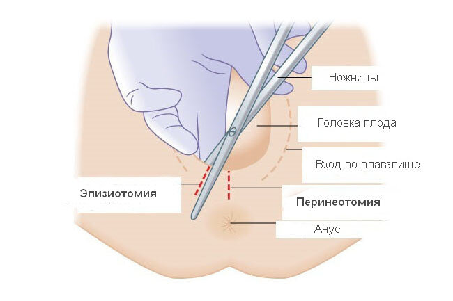 Как должен выглядеть шов после Роды без разрывов и разрезов Дракон старой гвардии Дзен