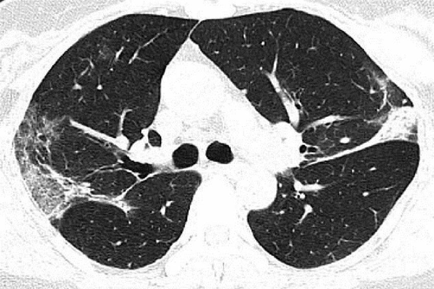 Снимок лёгких зараженного пациента