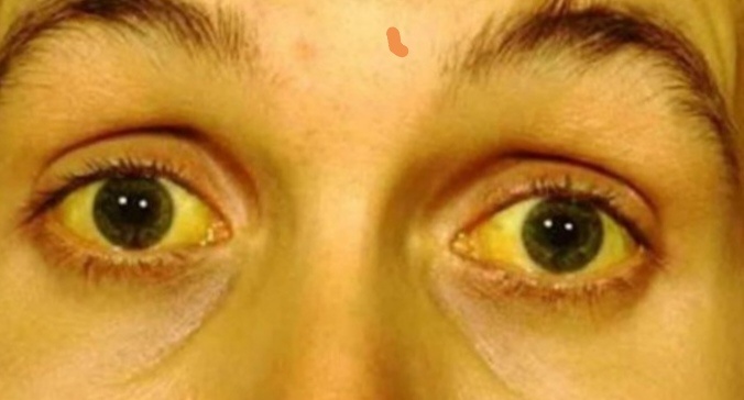 Примерно так и выглядит, возможно не заметно, но зрачки обычно тоже желтеют. 