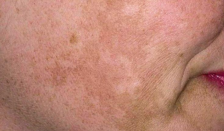 Хлоазма кожи