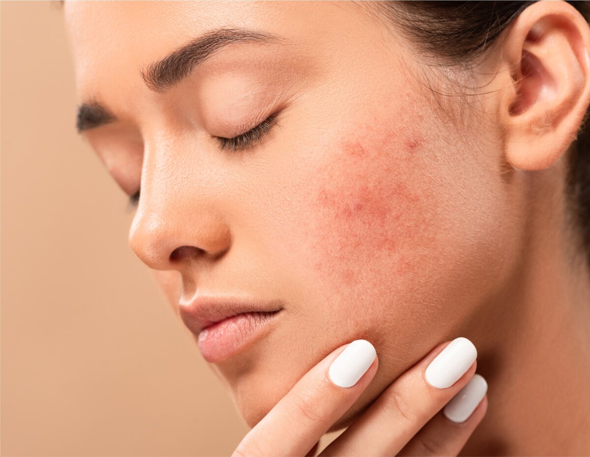 Пятна и рубцы после прыщей. Почему так важно вовремя обратиться к врачу