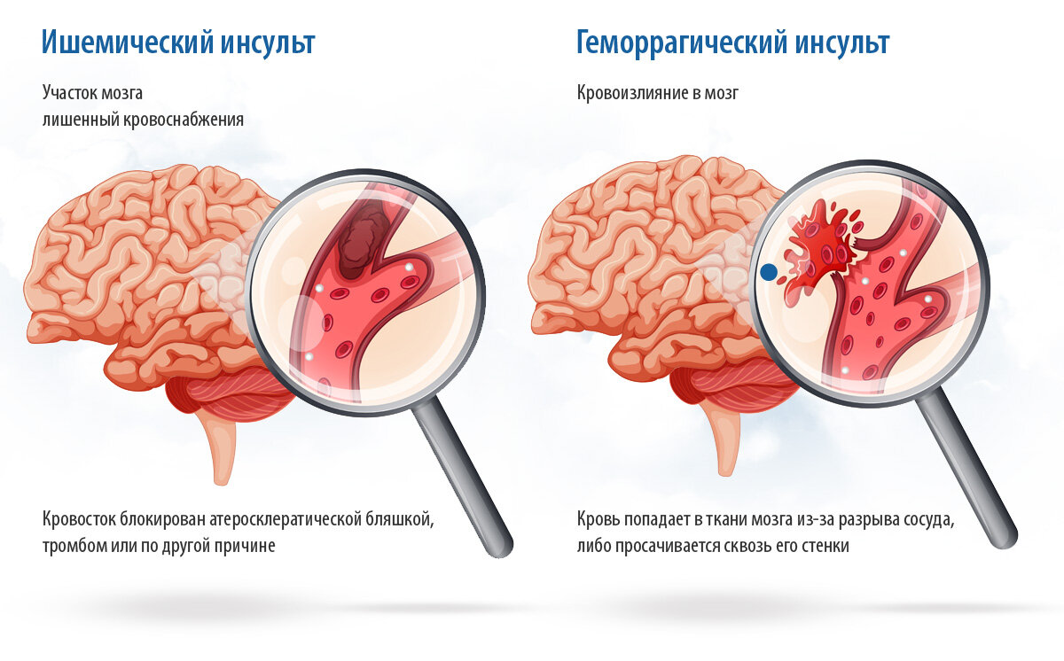 ИНСУЛЬТ-ПРИВЕТ, ТО ЛИ ИСТОРИЯ БОЛЕЗНИ, ТО ЛИ ИСТОРИЯ ЗДОРОВЬЯ, ВРЕМЯ  ПОКАЖЕТ. часть последняя. | Дмитрий Пейпонен | Дзен