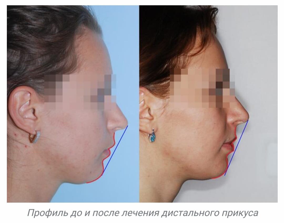 Операция на челюсть. Ортогнатическая хирургия дистальный прикус. Дистальный прикус верхней челюсти. Дистальный прикус подбородок. Прогнатический прикус до и после.