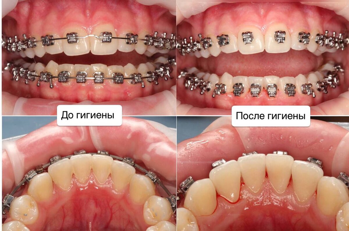 Зачем нужна регулярная профессиональная гигиена при ортодонтическом  лечении? | Марков Николай Михайлович | Дзен