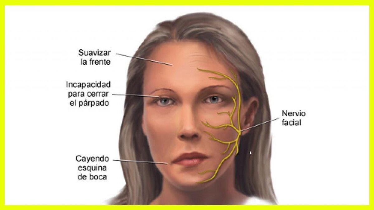 Лицевой нерв слева. Неврит лицевого нерва Центральный паралич. Невропатия лицевого нерва.