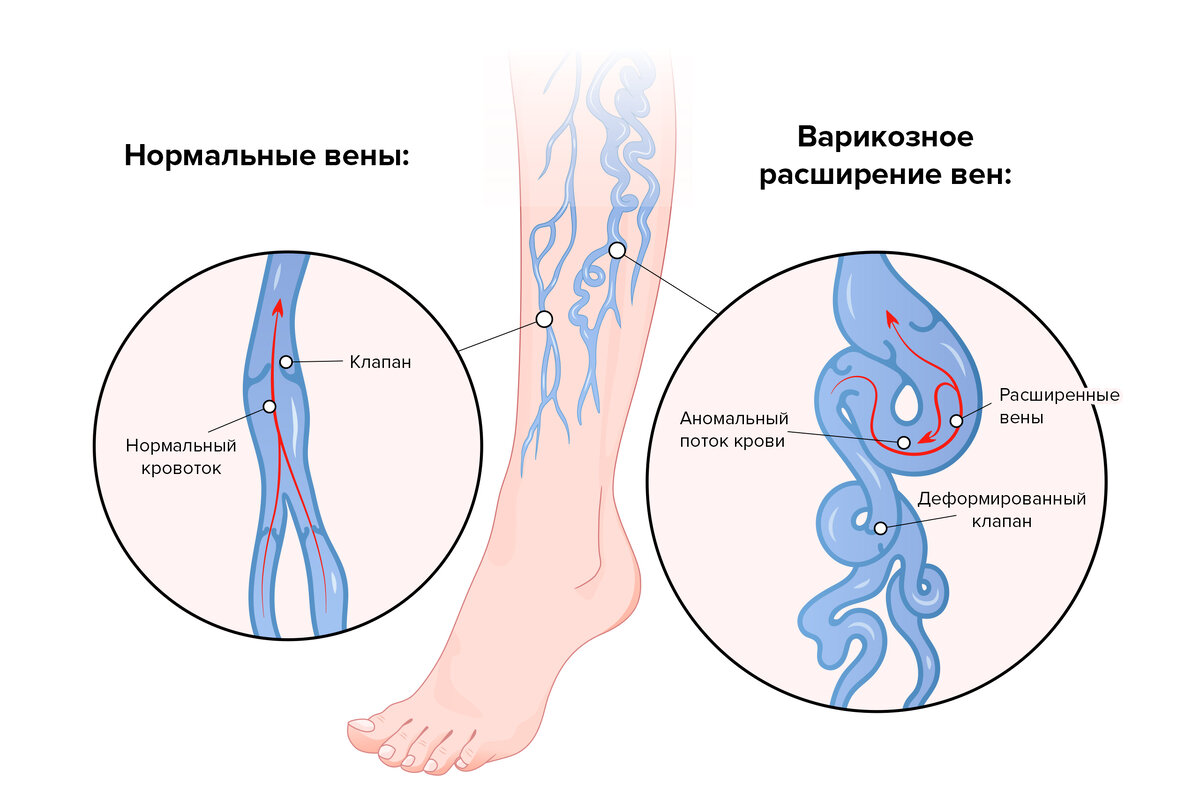 Варикоз у подростков: профилактика и диагностика