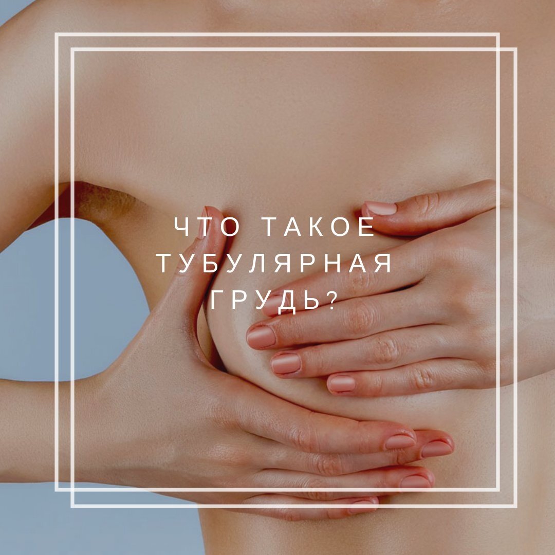 тубулярная деформация груди у женщин фото 47