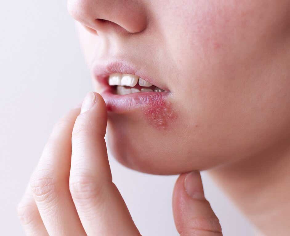 Герпес на губах