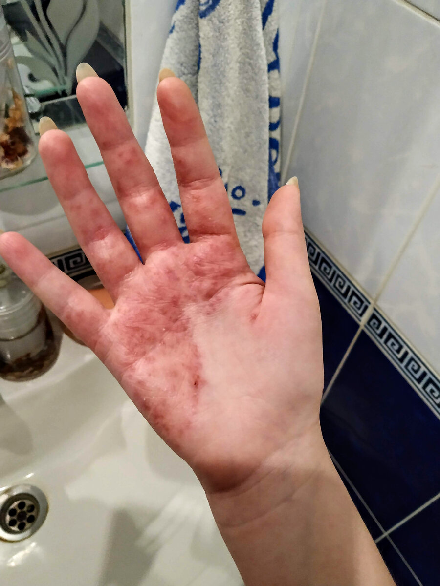 Начинается обострение