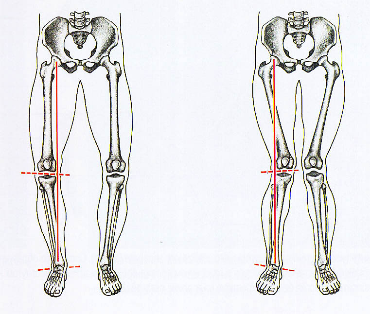 Нижние конечности тела. Вальгусная деформация бедренной кости. Вальгусная деформация оси конечности. Варусная деформация оси нижних конечностей. Варусная деформация бедренной кости.