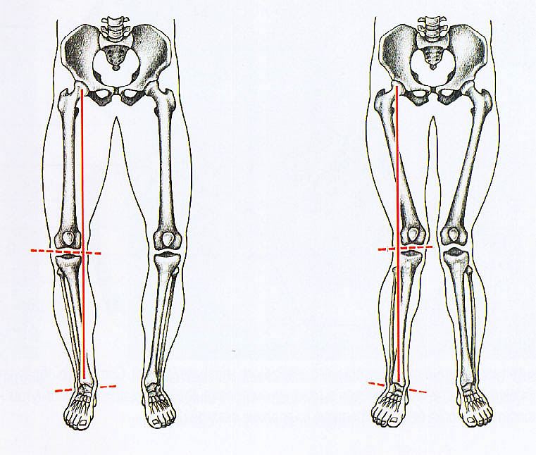 Картинки нижние конечности. Варусная деформация оси нижних конечностей. Анатомическая ось бедренной кости. Кости таза и ног. Кости таза и нижних конечностей.