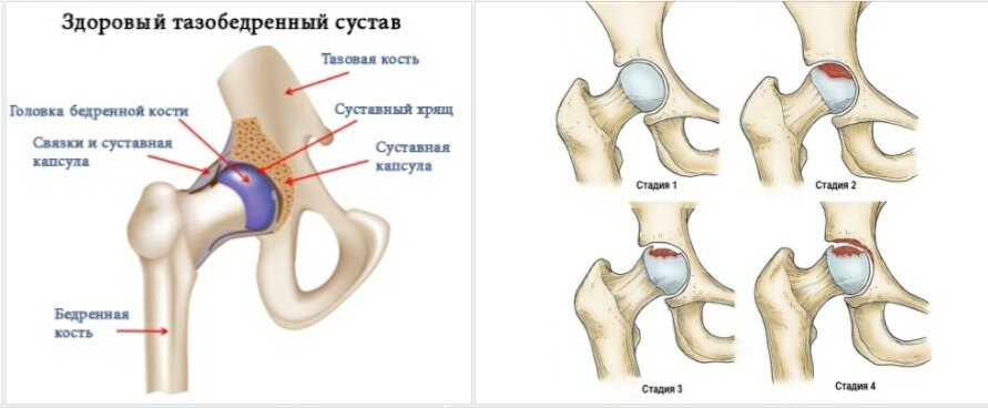 Здоровье тазобедренных суставов. Укрепление тазобедренного сустава. Связки укрепляющие тазобедренный сустав. Укрепление связок. Что такое двусторонний коксартроз голеностопного сустава.