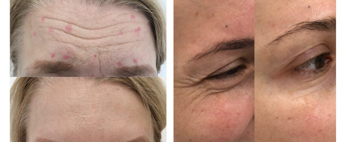 Ботулинотерапия. Фото до и после. Фото с сайта Д.Р. Гришкяна. Имеются противопоказания, требуется консультация специалиста