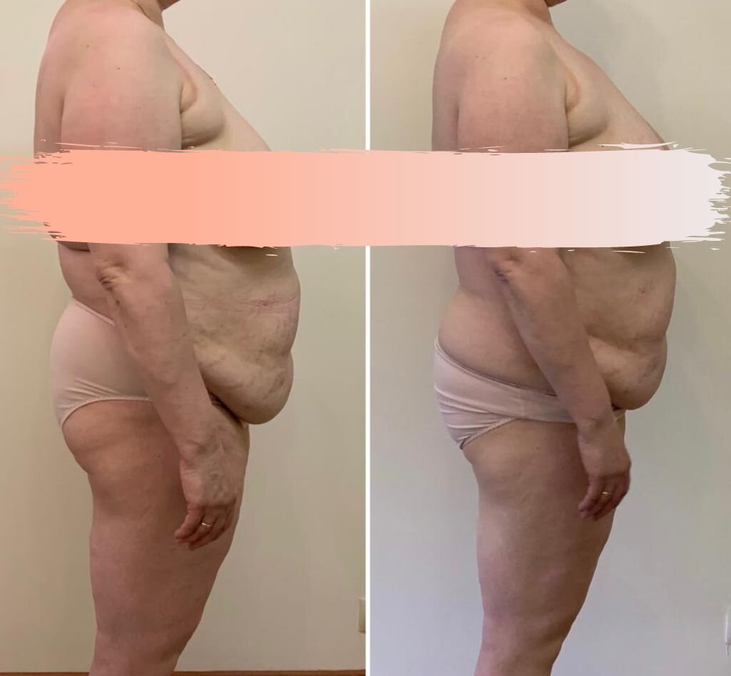 Фото до/после — два сеанса в техниках Ладание и Остеопластика. На первом мы сделали Ладание, чтобы убрать напряжения, запустить внутренние процессы самовосстановления. Женщина рассказала, что после этого организм сильно почистился от накопившегося в кишечнике. С животом работала Остеопластикой.