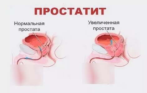 Народные средства от простатита и аденомы простаты