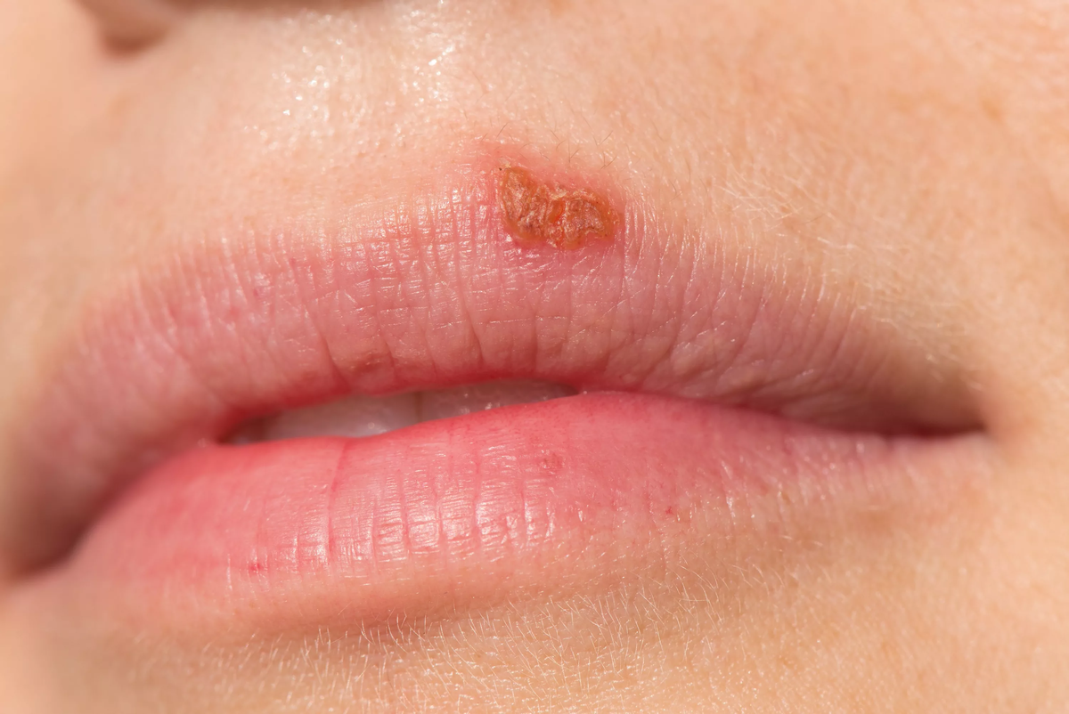 Насколько эффективно лечение герпеса на губах оксолиновой мазью?