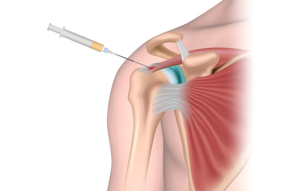 Сильный укол в суставы. Плазмотерапия суставов (PRP-терапия, плазмолифтинг). PRP плазмолифтинг суставов. Плазмолифтинг PRP терапия коленного сустава. Блокада плечевого сустава.