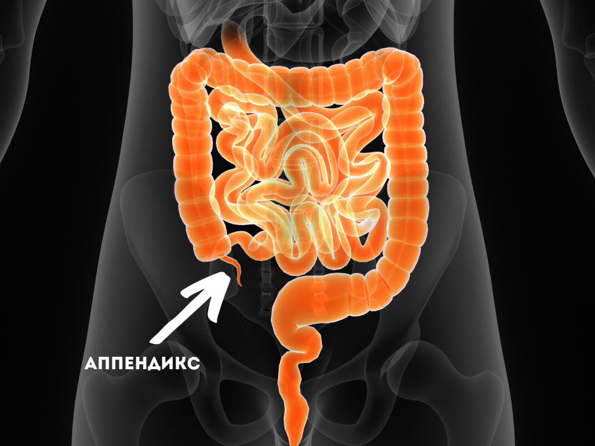 Аппендицит картинка человека