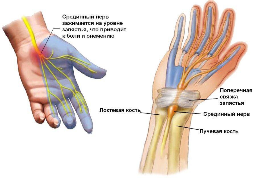 Немеет рука правая причины кисть и пальцы