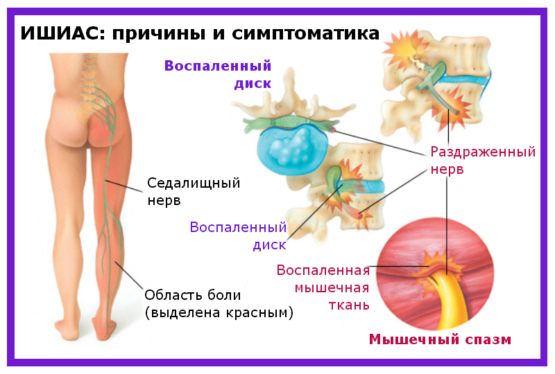 Ишиас карта смп