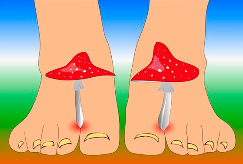 6 способов безопасного лечения грибка на ногах в домашних условиях