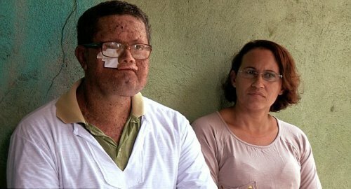 Пигментная ксеродерма