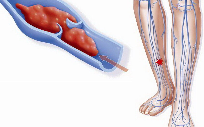 Чаще всего крупные тромбы локализуются в сосудах нижних конечностей, но при COVID 19 - поражаются мелкие сосуды лёгких.